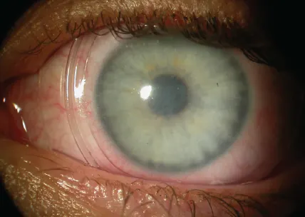 amniotic membrane on eye