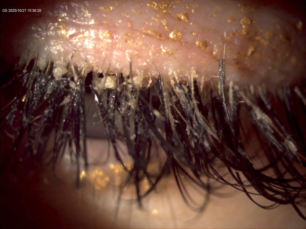 extreme blepharitis on patient with eyelash extensions