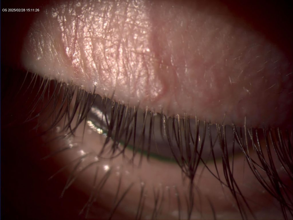blepharitis patient dr. madan